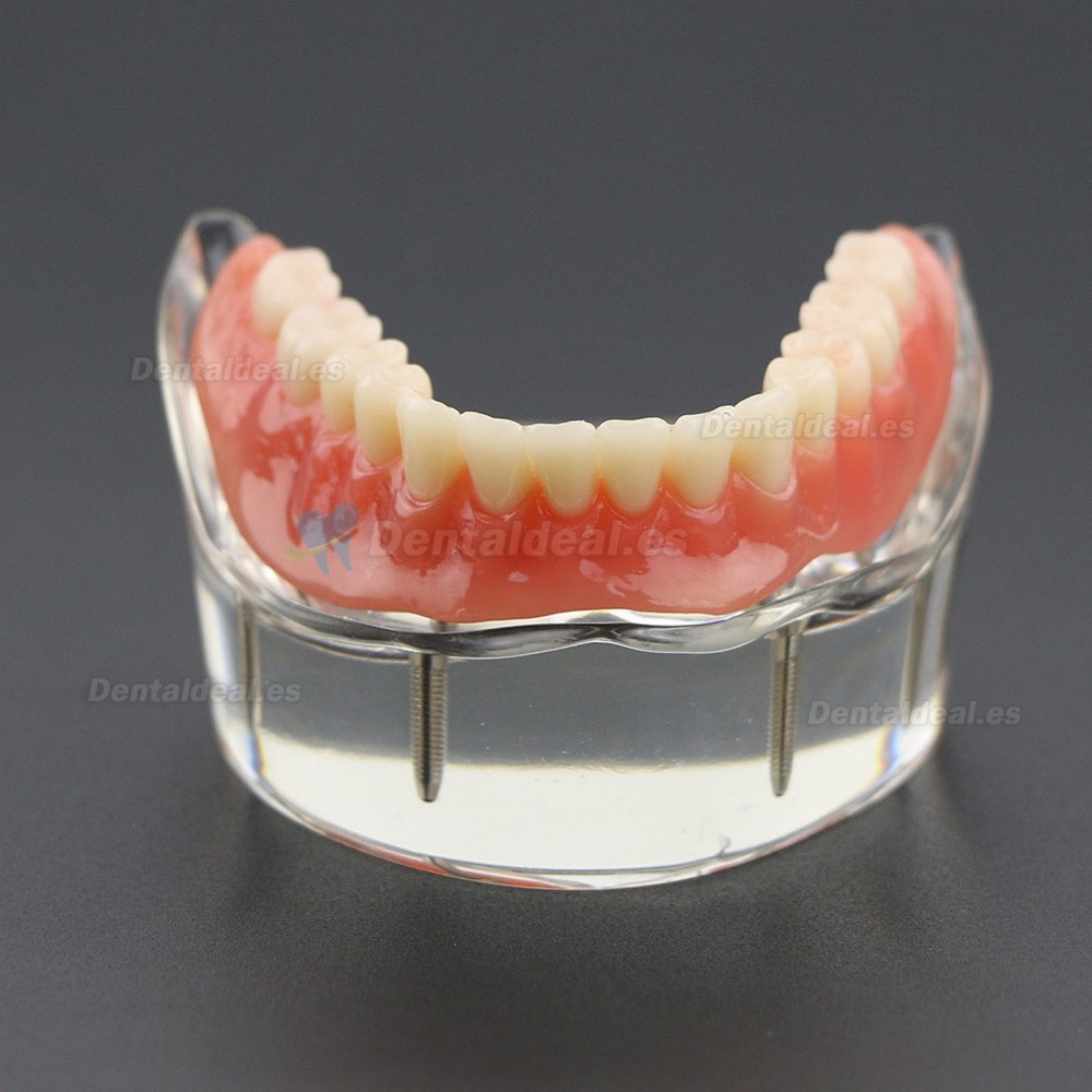 Dientes inferiores dental Modelo de sobredentadura 4 implantes Demostración Modelo 6002 02